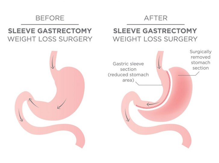 Before and After Sleeve Gastrectomy Weight Loss Surgery